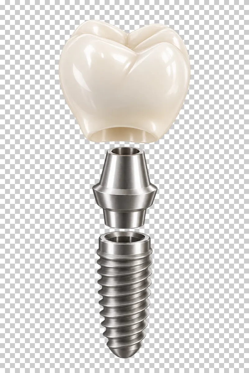 Exploded dental implant assembly with an ivory crown, abutment and threaded metal post.