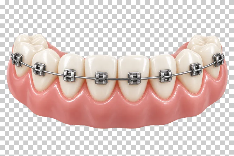Ivory teeth and pink gums fitted with metal brackets and a continuous archwire.